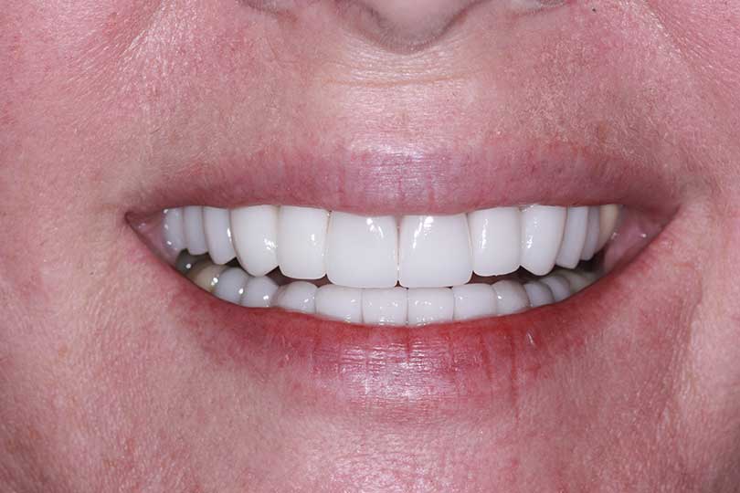 After Procedure