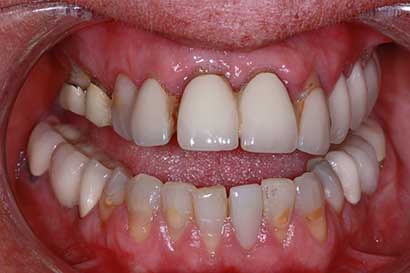 Before Procedure