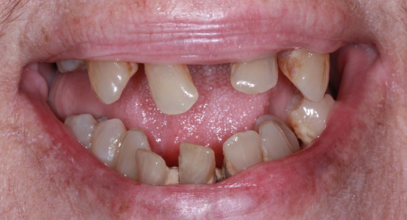 Before Procedure