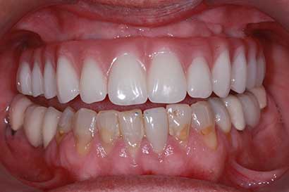 After Procedure
