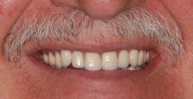 After Procedure