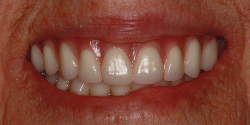 After Procedure